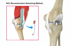 ACL Reconstruction Procedure of Hamstring Tendon