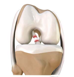 Anterior Cruciate Ligament (ACL) Tears