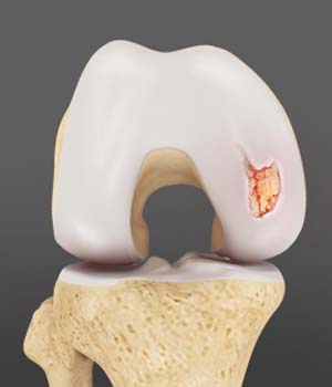 Chondral (Articular Cartilage) Defects