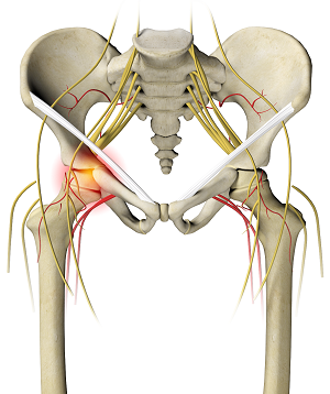 Irritable Hip