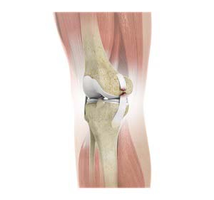 Anterior Cruciate Ligament (ACL) Tears