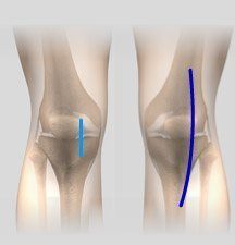 Minimally or Less Invasive Total Knee Arthroplasty 