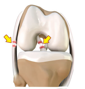 Multi-ligament Injuries