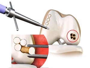 OATs (Osteochondral Autologous Transfer Surgery)