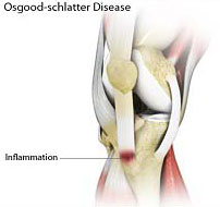 Osgood Schlatter