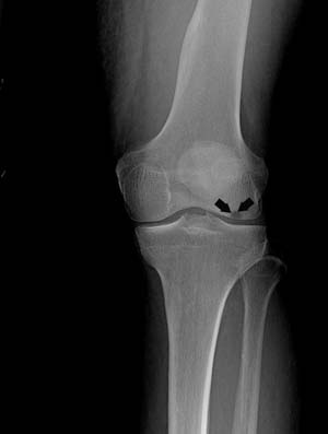 Osteonecrosis of The Knee