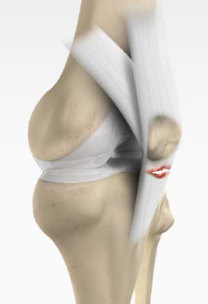 Patella Tendon Rupture or Tear