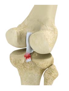 Posterior Cruciate Ligament Injuries