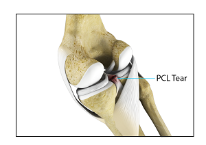 Posterior Cruciate Ligament Injuries