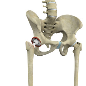 Revision Total Hip Replacement