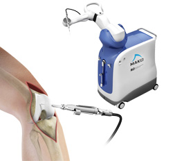 Mako Robotic Partial Knee Replacement