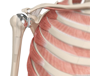 Shoulder Joint Replacement