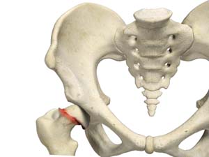 Slipped Capital Femoral Epiphysis