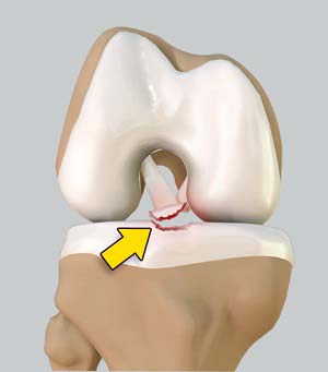 Anterior Cruciate Ligament (ACL) Tears